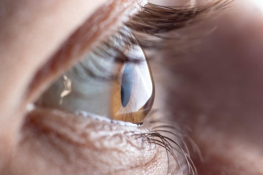 A closeup of an astigmatic eye