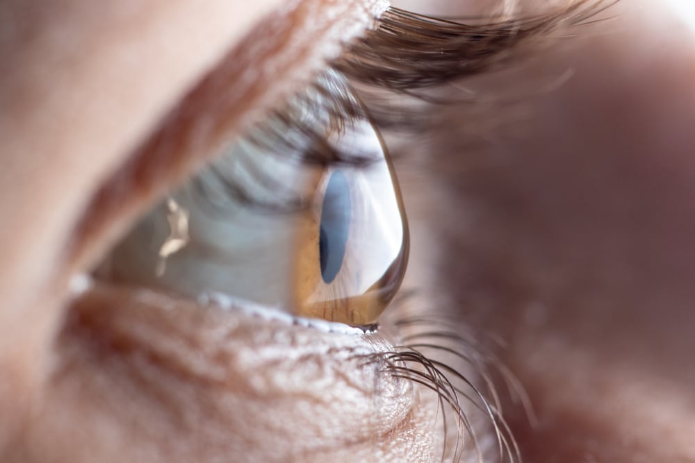Astigmatic Eye A closeup of an astigmatic eye