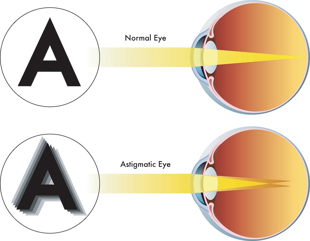 An infographic showing how astigmatism affects the human eye